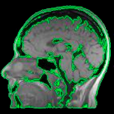 Chan-Vese Segmentation